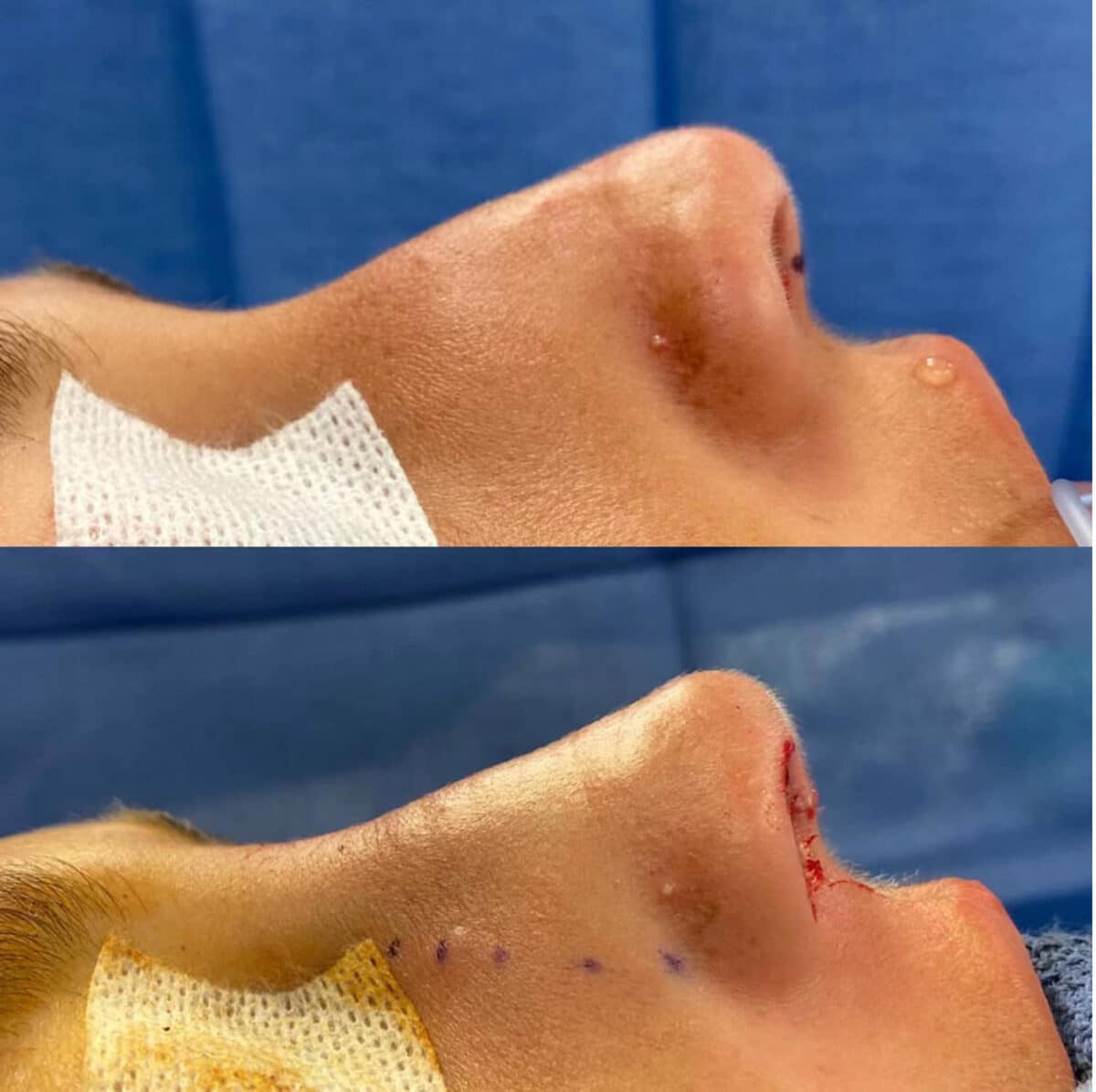 Immediate Rhinoplasty Before and After Photos in Philadelphia, PA, Patient 3399