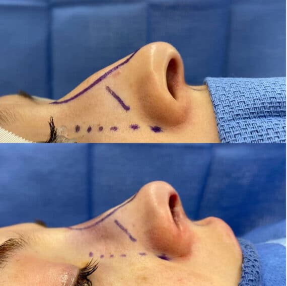 Immediate Rhinoplasty Before and After Photos in Philadelphia, PA, Patient 3401