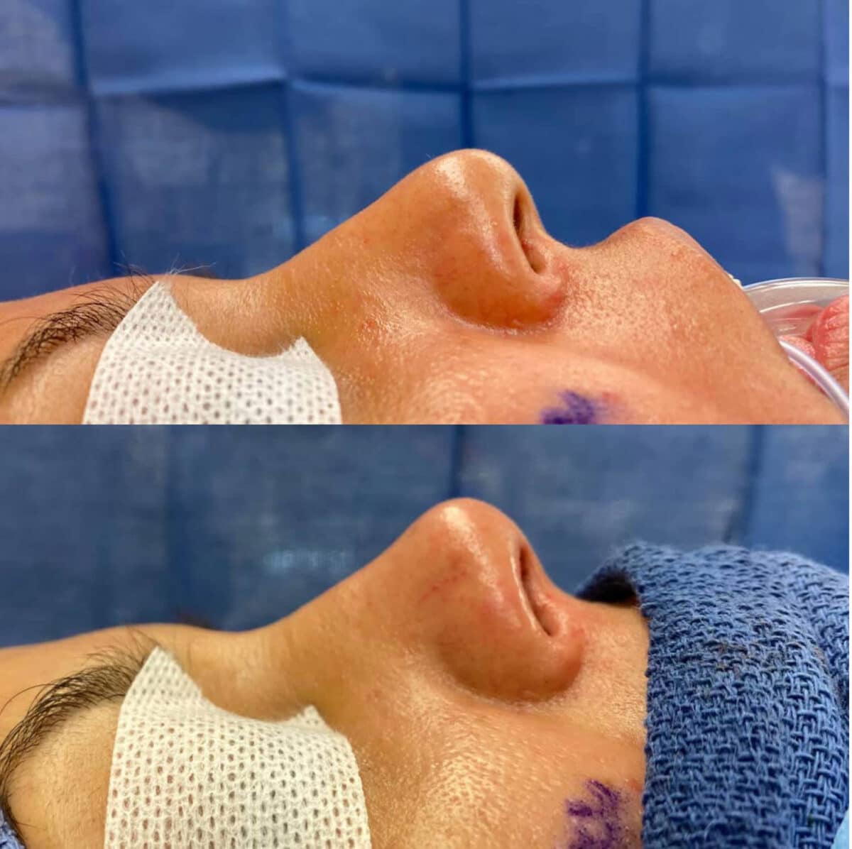 Immediate Rhinoplasty Before and After Photos in Philadelphia, PA, Patient 3403