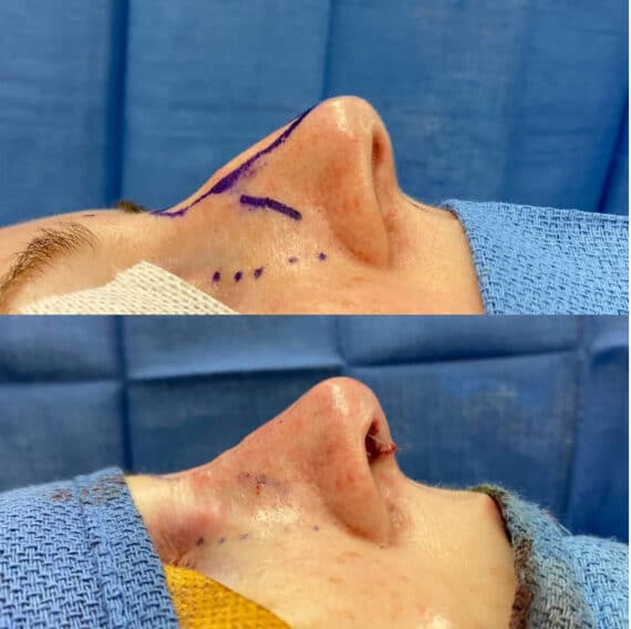 Immediate Rhinoplasty Before and After Photos in Philadelphia, PA, Patient 3405