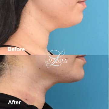 Liposuction Before and After Photos in Philadelphia, PA, Patient 3417
