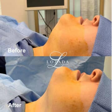 Liposuction Before and After Photos in Philadelphia, PA, Patient 3421