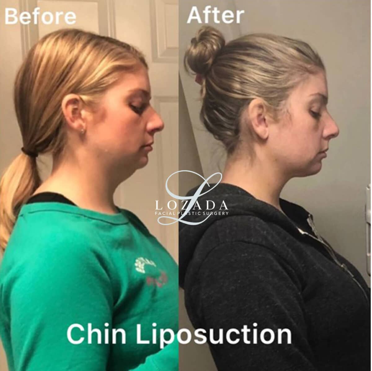 Liposuction Before and After Photos in Philadelphia, PA, Patient 3425