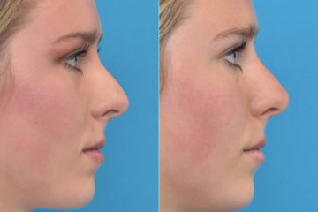 Liquid Rhinoplasty Before and After Photos in Philadelphia, PA, Patient 3433