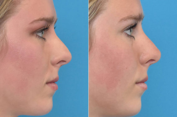 Liquid Rhinoplasty Before and After Photos in Philadelphia, PA, Patient 3433