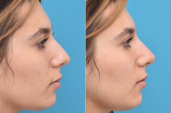 Liquid Rhinoplasty Before and After Photos in Philadelphia, PA, Patient 3459