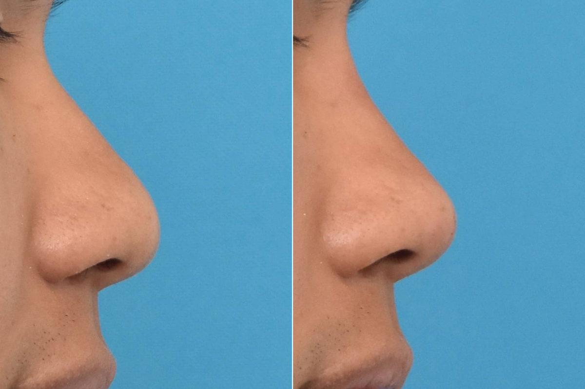 Liquid Rhinoplasty Before and After Photos in Philadelphia, PA, Patient 3461