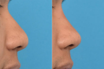 Liquid Rhinoplasty Before and After Photos in Philadelphia, PA, Patient 3461