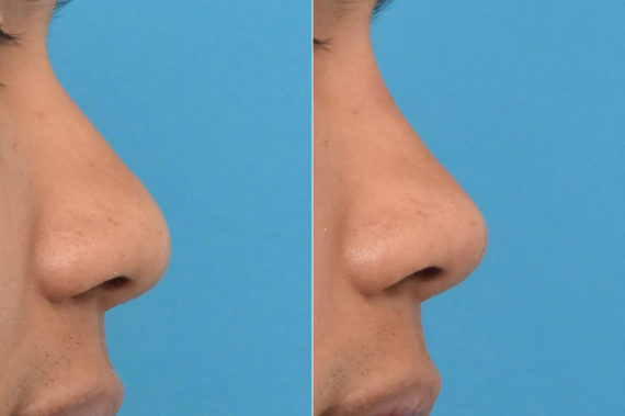 Liquid Rhinoplasty Before and After Photos in Philadelphia, PA, Patient 3461