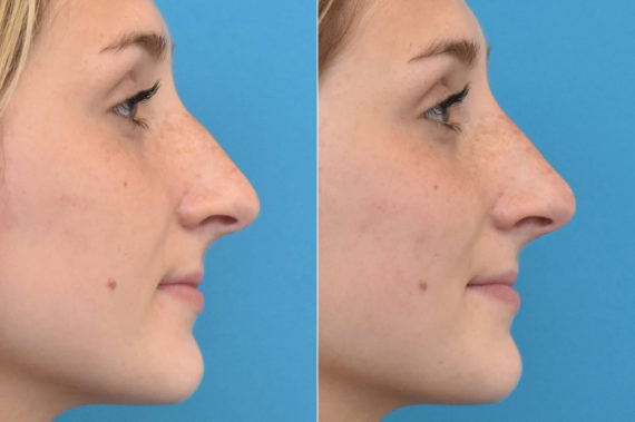 Liquid Rhinoplasty Before and After Photos in Philadelphia, PA, Patient 3463