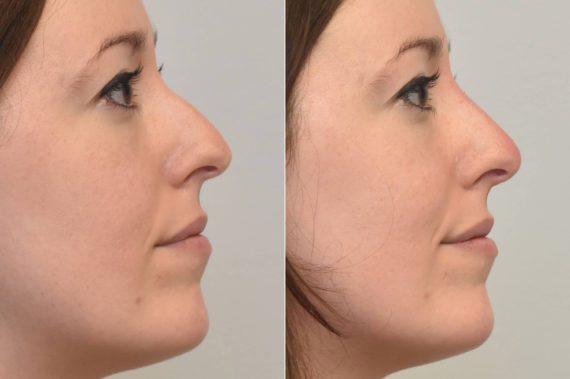 Liquid Rhinoplasty Before and After Photos in Philadelphia, PA, Patient 3465