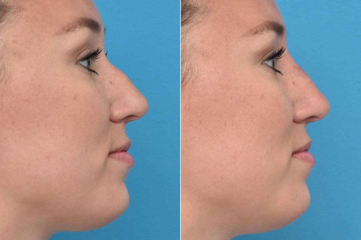 Liquid Rhinoplasty Before and After Photos in Philadelphia, PA, Patient 3467