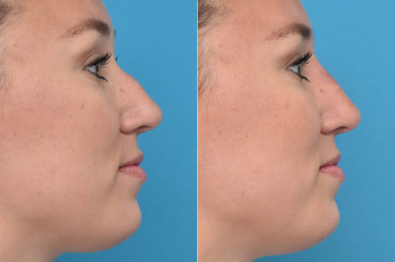 Liquid Rhinoplasty Before and After Photos in Philadelphia, PA, Patient 3467