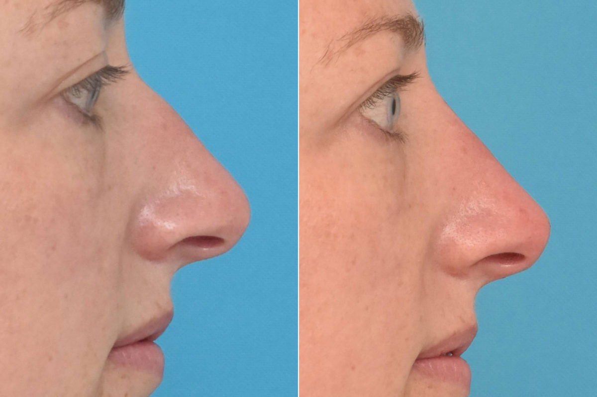 Liquid Rhinoplasty Before and After Photos in Philadelphia, PA, Patient 3469