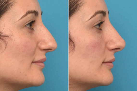 Liquid Rhinoplasty Before and After Photos in Philadelphia, PA, Patient 3471