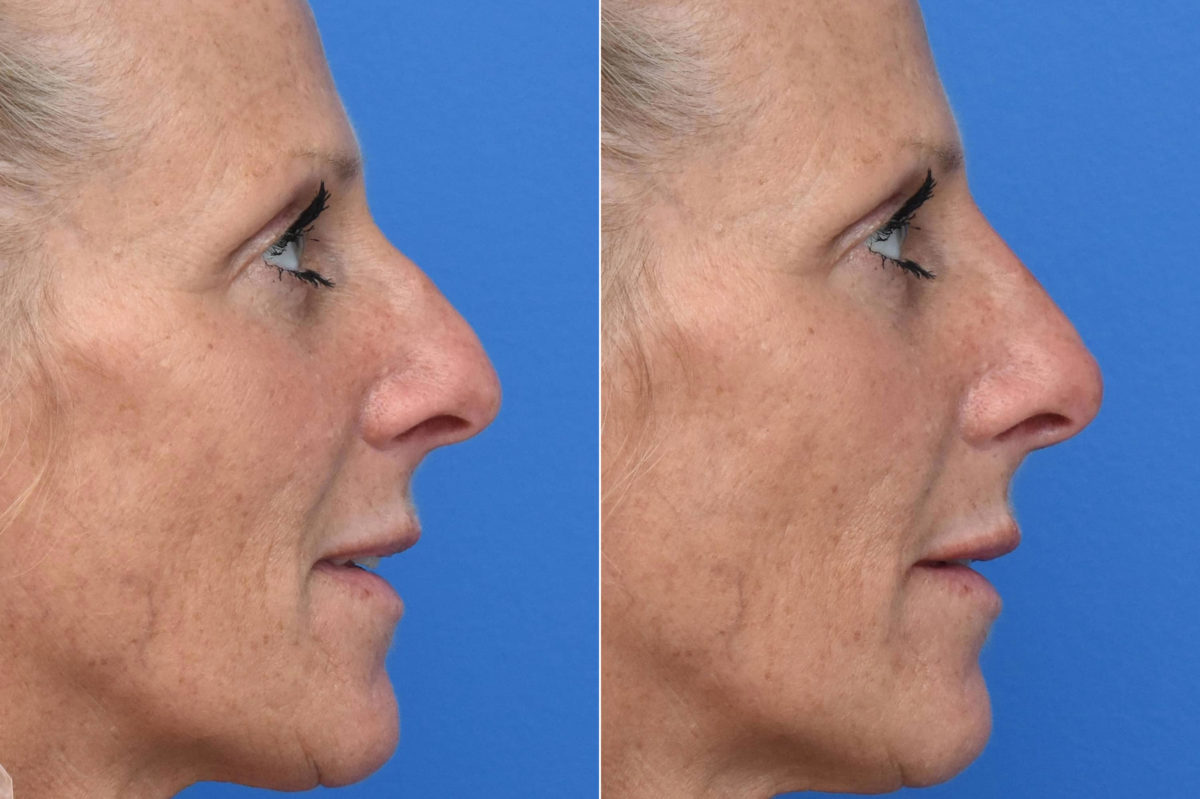 Liquid Rhinoplasty Before and After Photos in Philadelphia, PA, Patient 3473