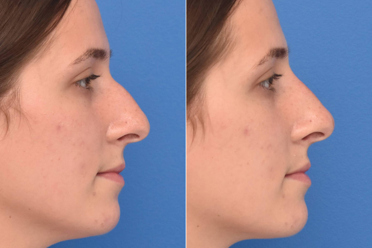 Liquid Rhinoplasty Before and After Photos in Philadelphia, PA, Patient 3475