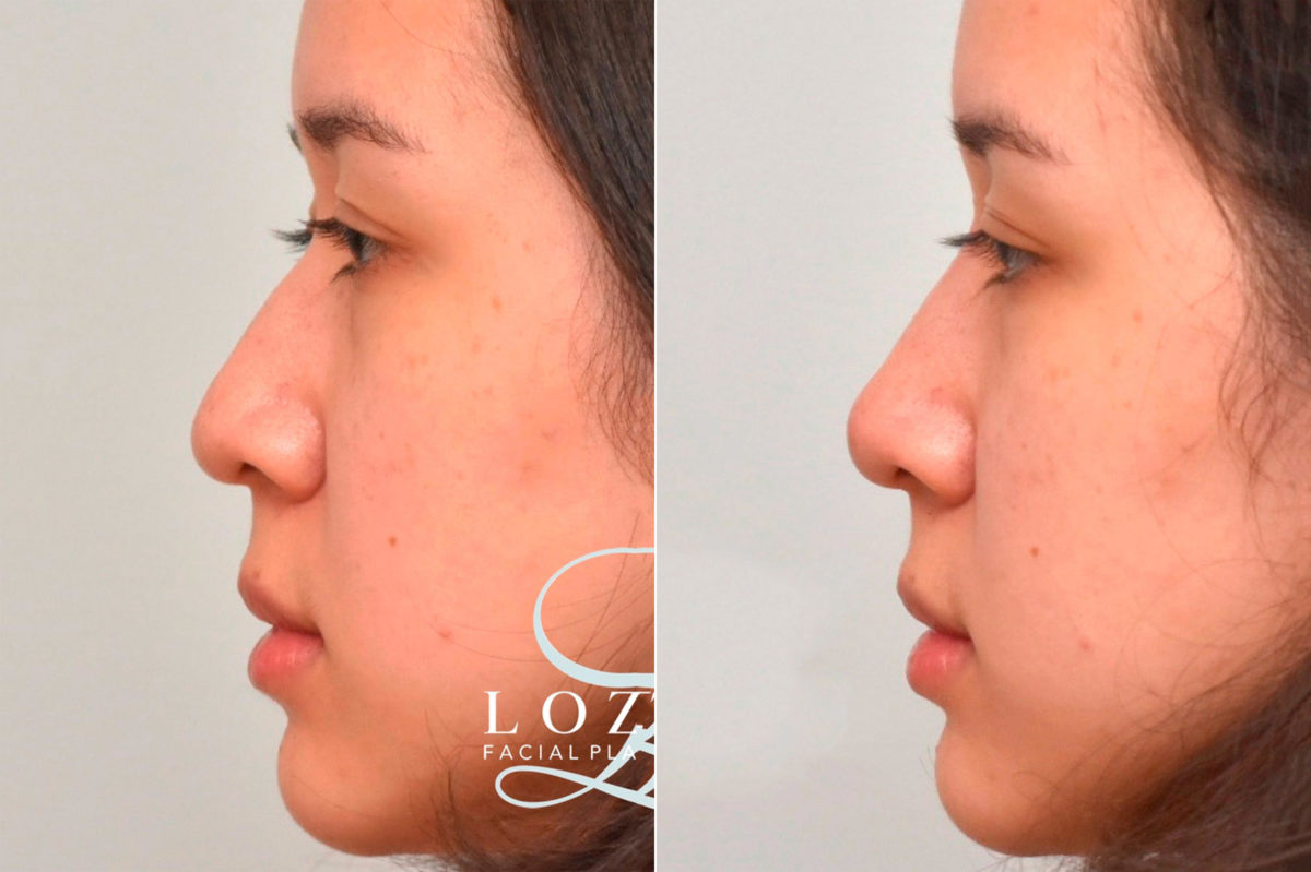 Liquid Rhinoplasty Before and After Photos in Philadelphia, PA, Patient 3477