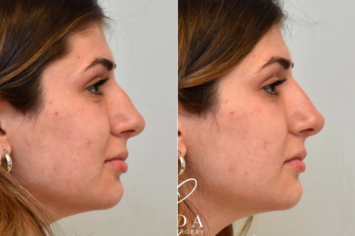 Liquid Rhinoplasty Before and After Photos in Philadelphia, PA, Patient 3479