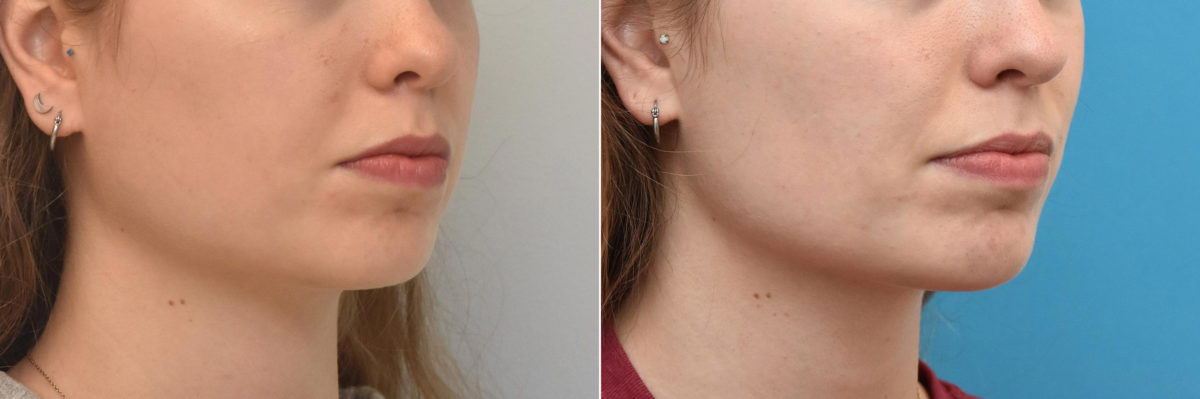 Facial Slimming Before and After Photos in Philadelphia, PA, Patient 3481