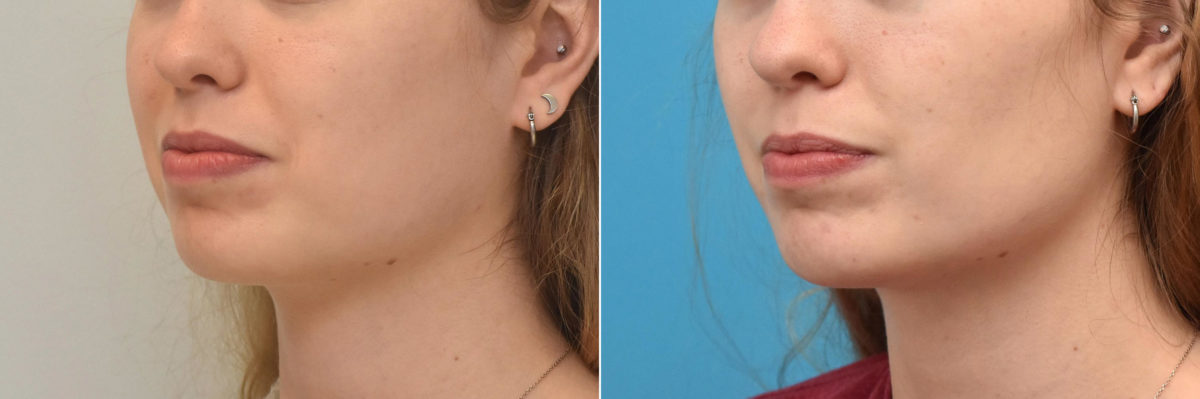 Facial Slimming Before and After Photos in Philadelphia, PA, Patient 3481