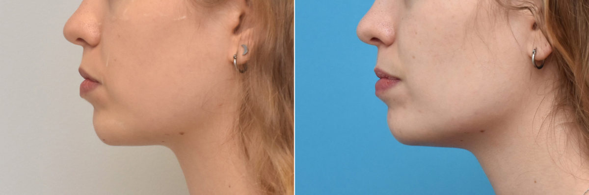 Facial Slimming Before and After Photos in Philadelphia, PA, Patient 3481