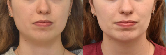 Facial Slimming Before and After Photos in Philadelphia, PA, Patient 3481