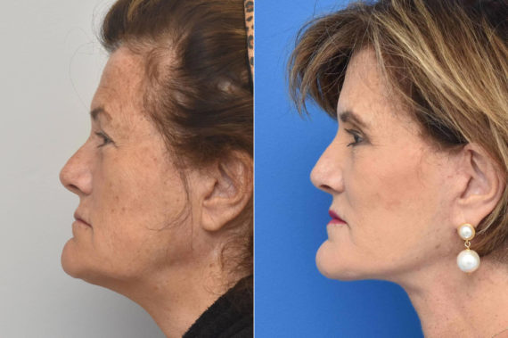 Facelift Before and After Photos in Philadelphia, PA, Patient 3497