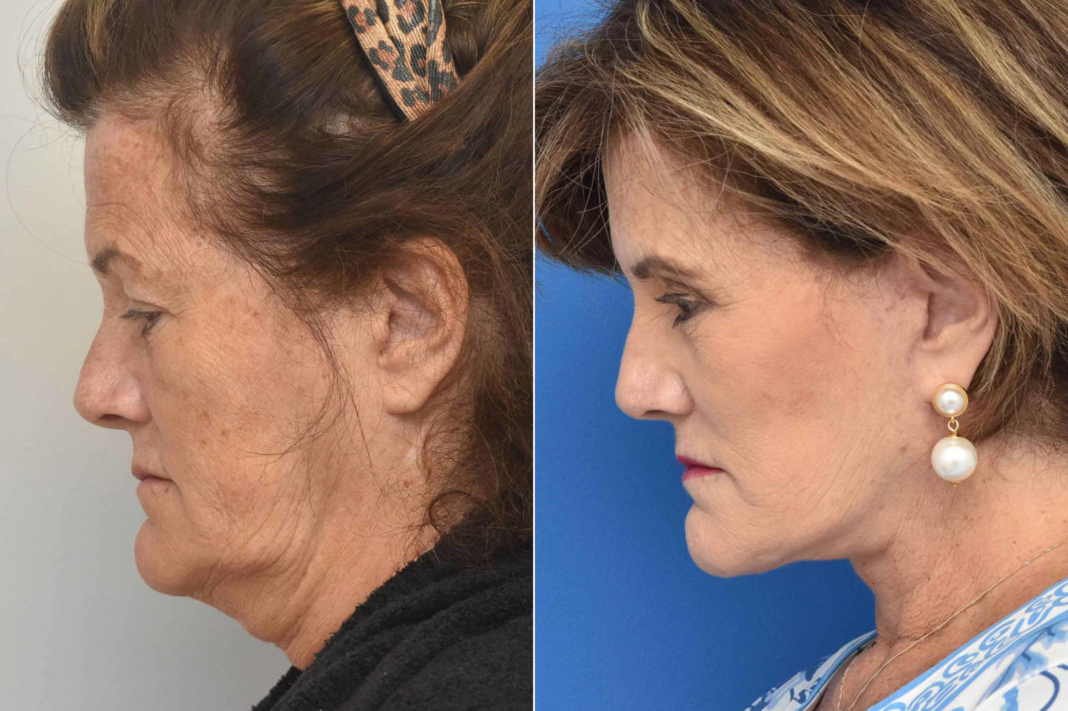 Facelift Before and After Photos in Philadelphia, PA, Patient 3497