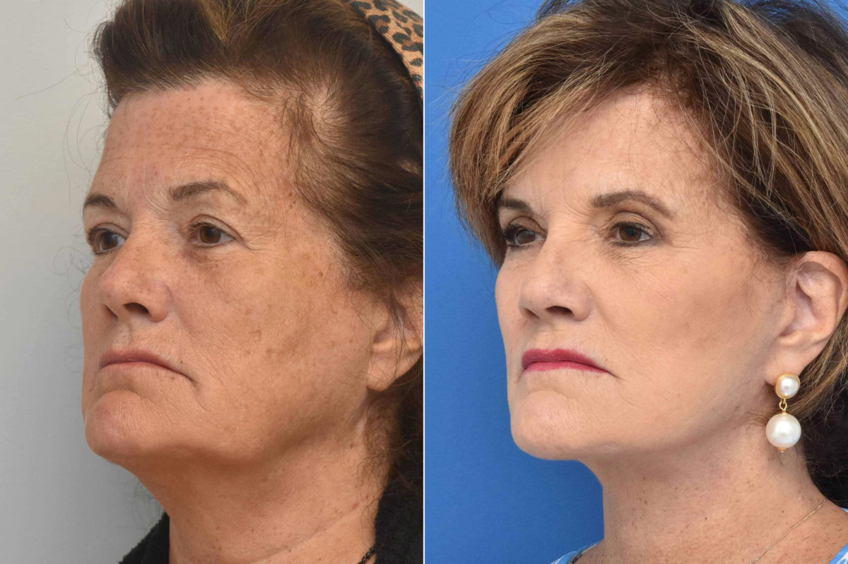 Facelift Before and After Photos in Philadelphia, PA, Patient 3497