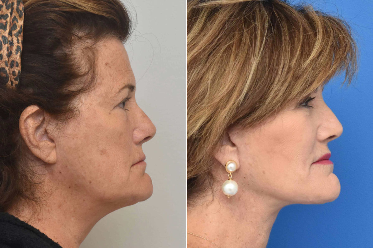 Facelift Before and After Photos in Philadelphia, PA, Patient 3497