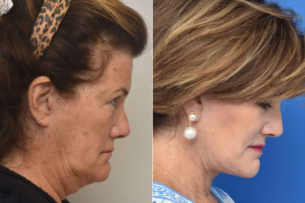 Facelift Before and After Photos in Philadelphia, PA, Patient 3497