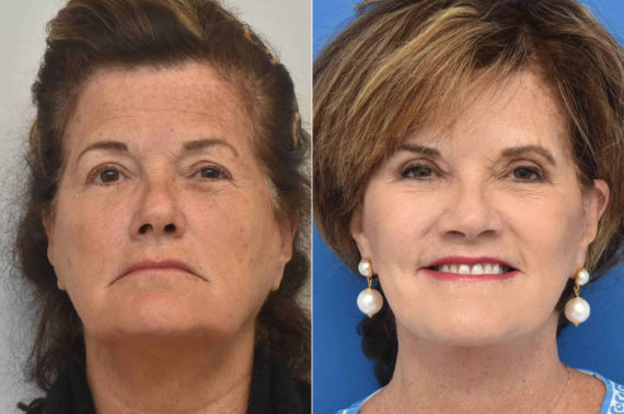 Facelift Before and After Photos in Philadelphia, PA, Patient 3497