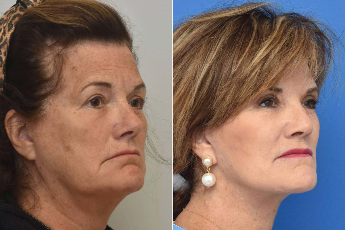 Facelift Before and After Photos in Philadelphia, PA, Patient 3497