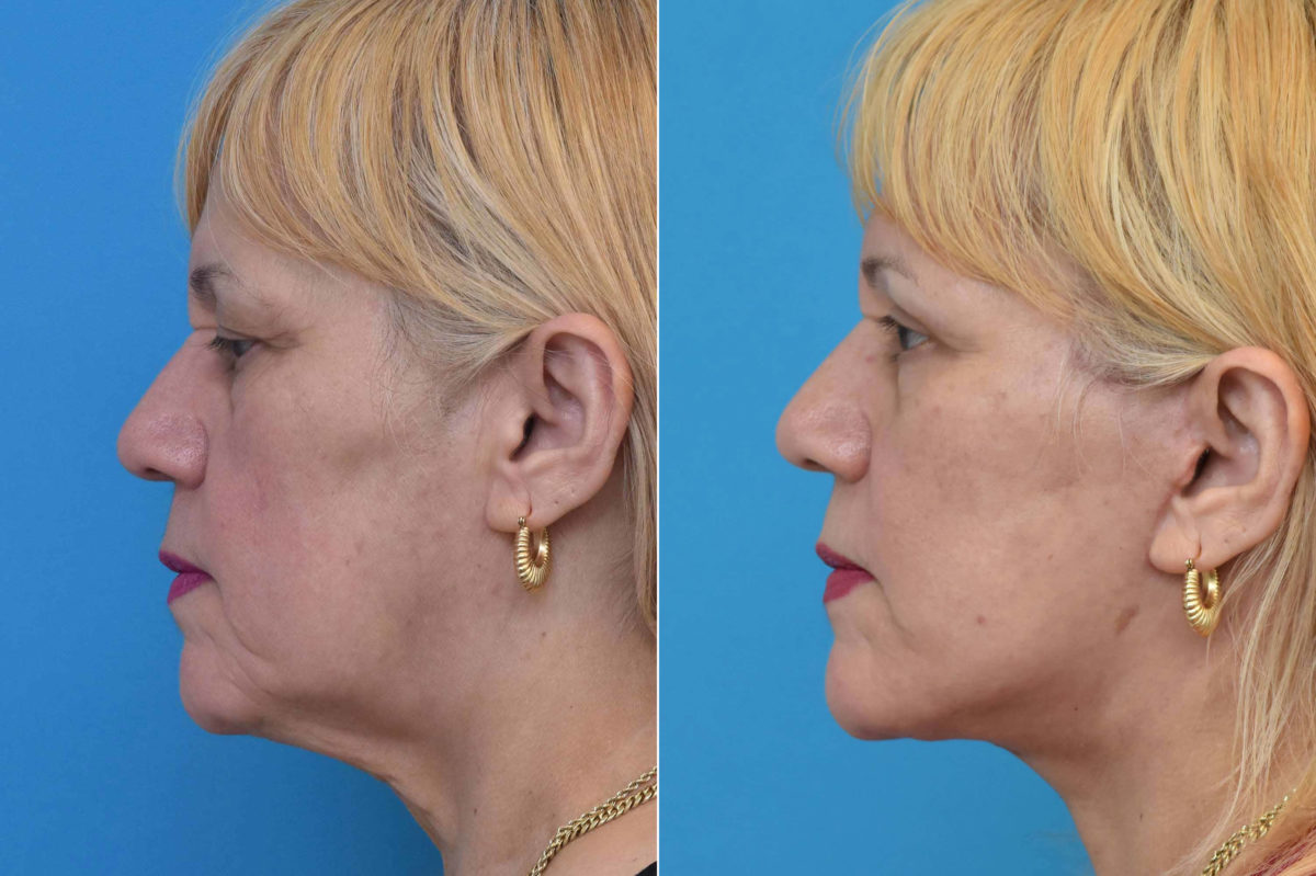 Facelift Before and After Photos in Philadelphia, PA, Patient 3534