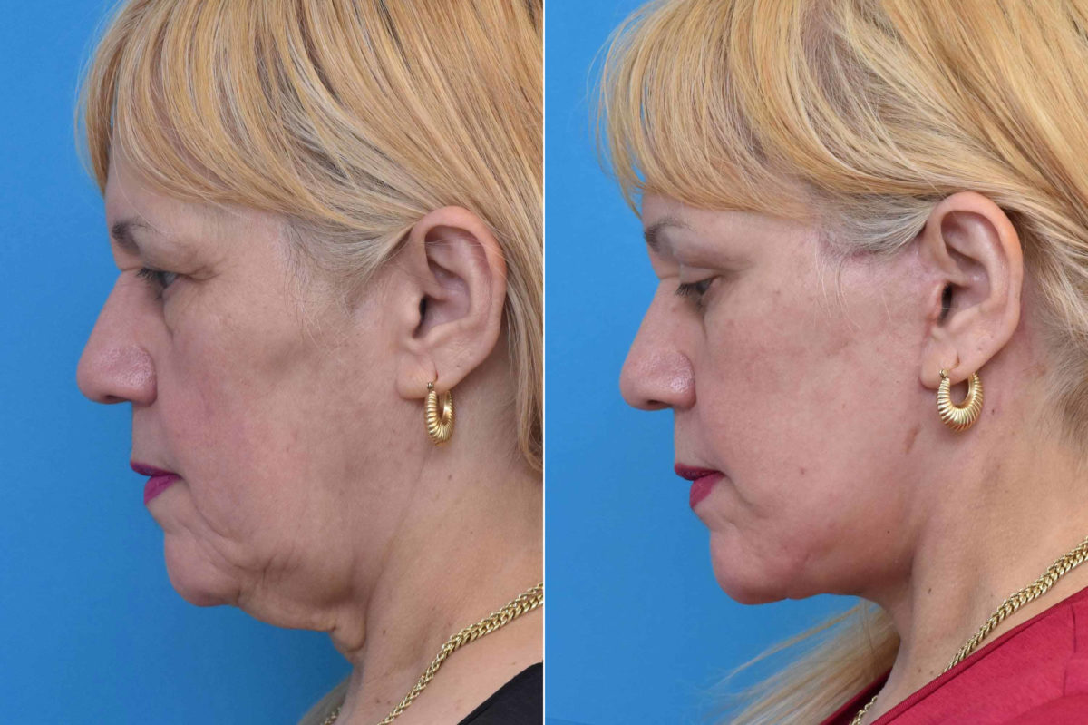 Facelift Before and After Photos in Philadelphia, PA, Patient 3534