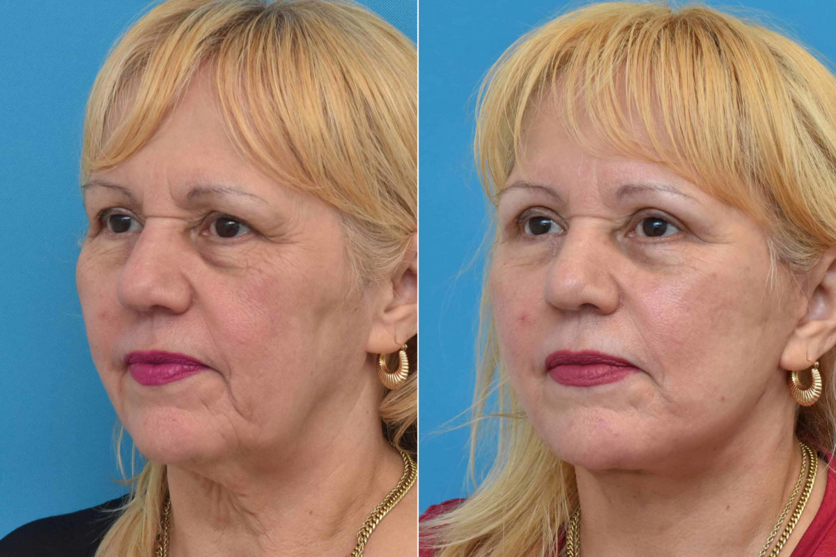 Facelift Before and After Photos in Philadelphia, PA, Patient 3534