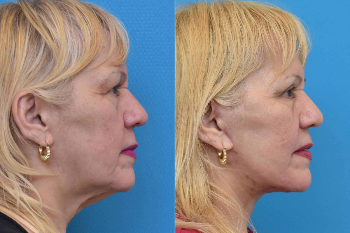 Facelift Before and After Photos in Philadelphia, PA, Patient 3534