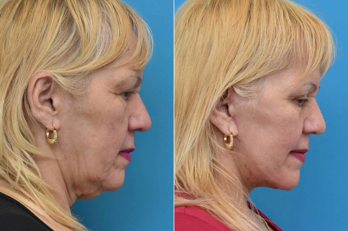 Facelift Before and After Photos in Philadelphia, PA, Patient 3534