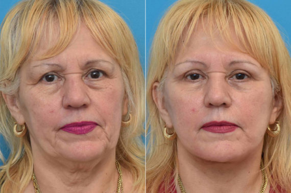 Facelift Before and After Photos in Philadelphia, PA, Patient 3534