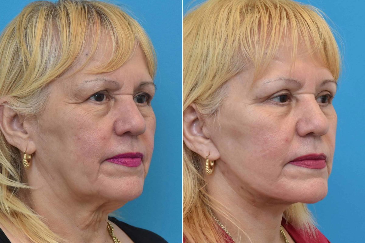 Facelift Before and After Photos in Philadelphia, PA, Patient 3534