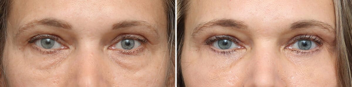 Lower Eyelid Surgery Before and After Photos in Princeton, NJ, Patient 3701