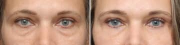 Lower Eyelid Surgery Before and After Photos in Princeton, NJ, Patient 3701