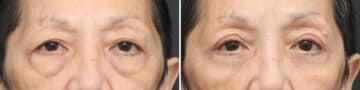 Lower Eyelid Surgery Before and After Photos in Princeton, NJ, Patient 3702