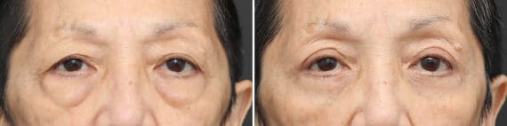 Lower Eyelid Surgery Before and After Photos in Princeton, NJ, Patient 3702