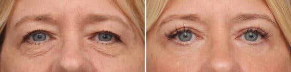 Lower Eyelid Surgery Before and After Photos in Princeton, NJ, Patient 3703