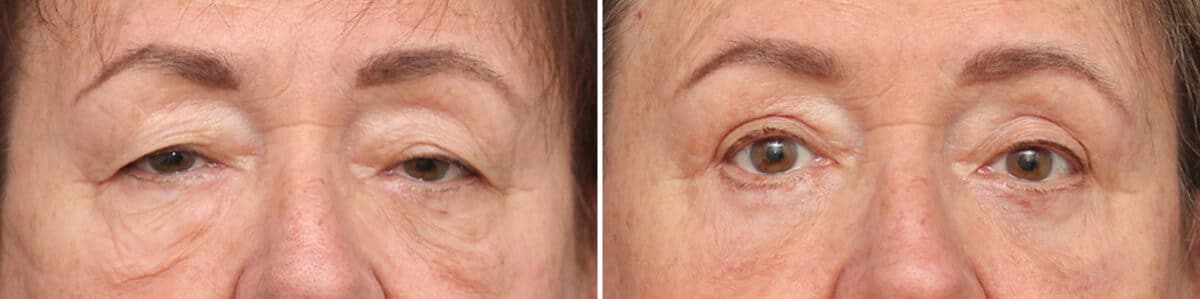 Lower Eyelid Surgery Before and After Photos in Princeton, NJ, Patient 3704