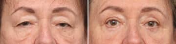 Lower Eyelid Surgery Before and After Photos in Princeton, NJ, Patient 3704