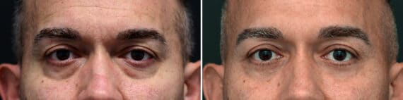 Lower Eyelid Surgery Before and After Photos in Princeton, NJ, Patient 3706