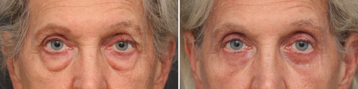 Lower Eyelid Surgery Before and After Photos in Princeton, NJ, Patient 3707